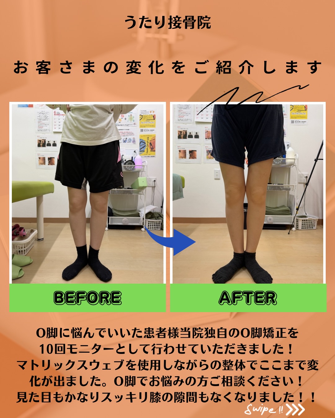 O脚、気になりますか？